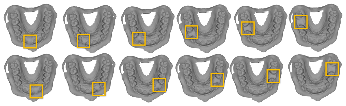 Examples of the MT3D dataset with 12 teeth removed per scan